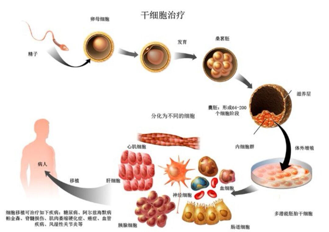 干细胞治疗糖尿病最新进展